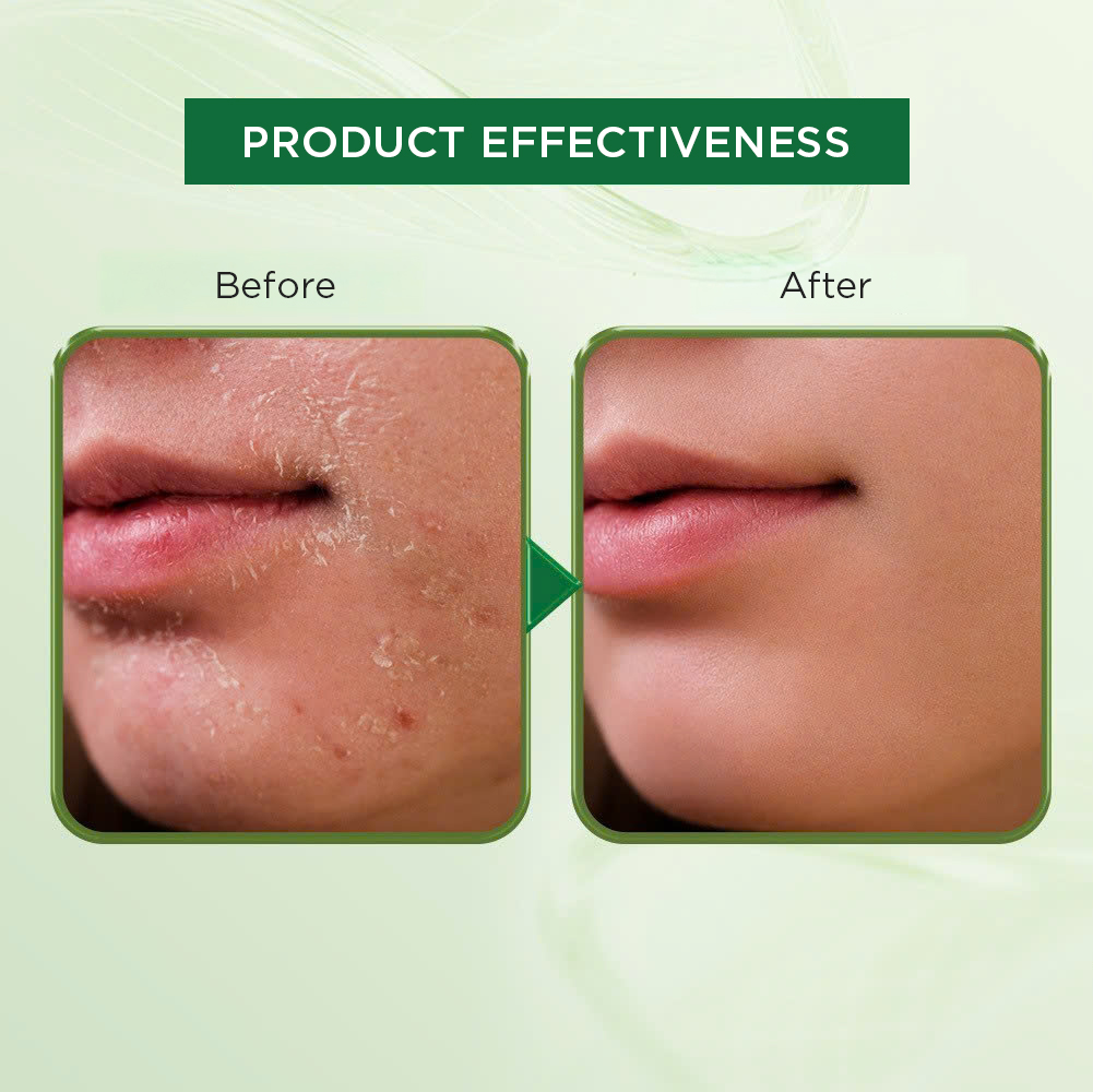 Bioessence Mask T - Tea Tree Sheet Mask | Helps Reduce Acne, Control Oil and Soothe Skin | 10 Sheets x 26ML - Image 5